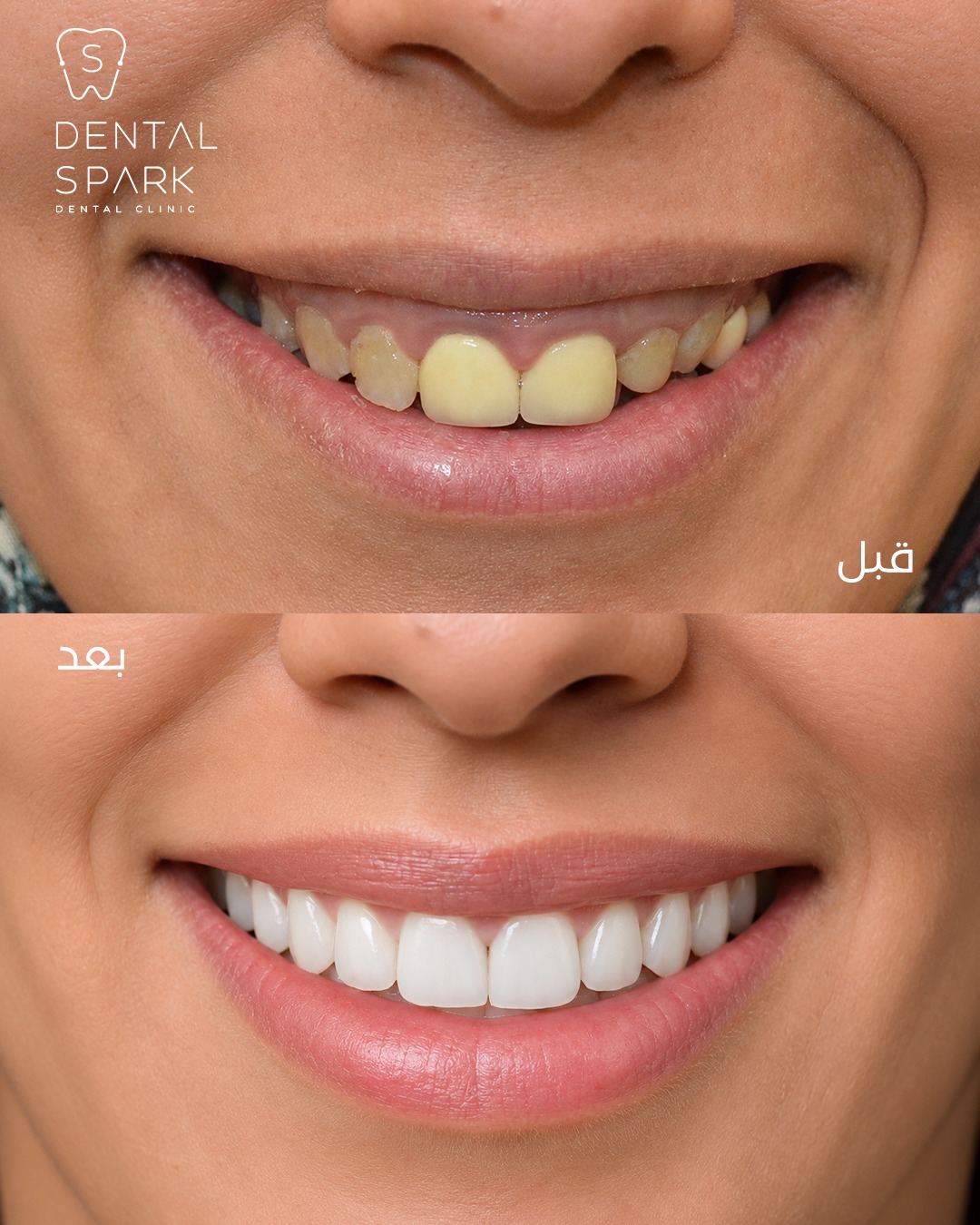 Before and After 6